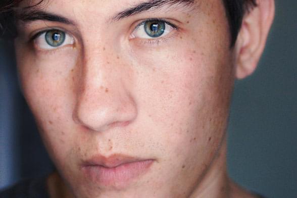 Teenage boy with acne