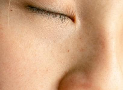 Young woman with acne