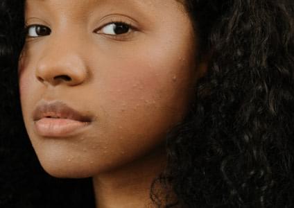 Young woman of colour with acne