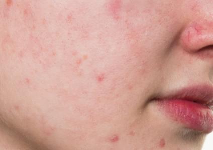 Young woman with acne
